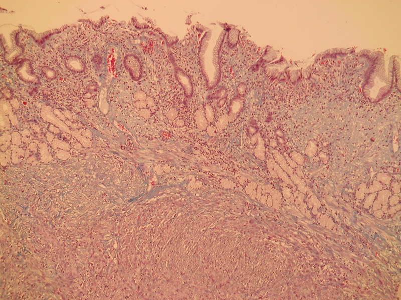 W górnej części zdjęcia błona śluzowa żołądka, a pod nią utkanie mięśniakomięsaka gładkomórkowego – barwienie histochemiczne trichrom Massona