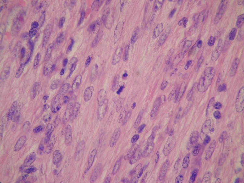 Obraz mikroskopowy mięśniakomięsaka gładkomórkowego żołądka – barwienie H+E