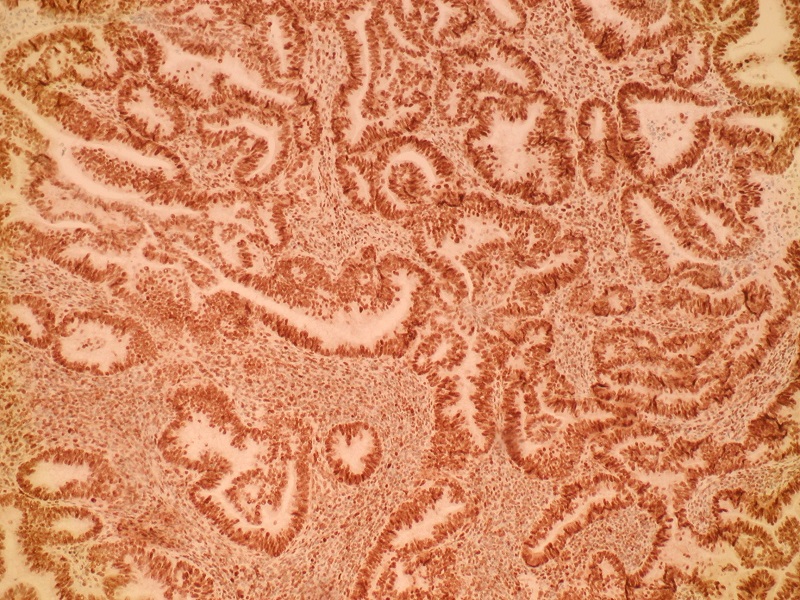 Rak gruczołowy endometrioidny (G-2) - pozytywna immunohistochemiczna ekspresja MLH