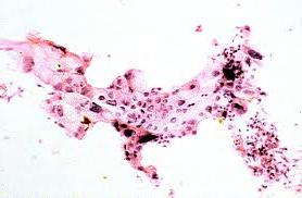 Obraz cytologiczny raka trzustki - materiał uzyskany drogą BAC