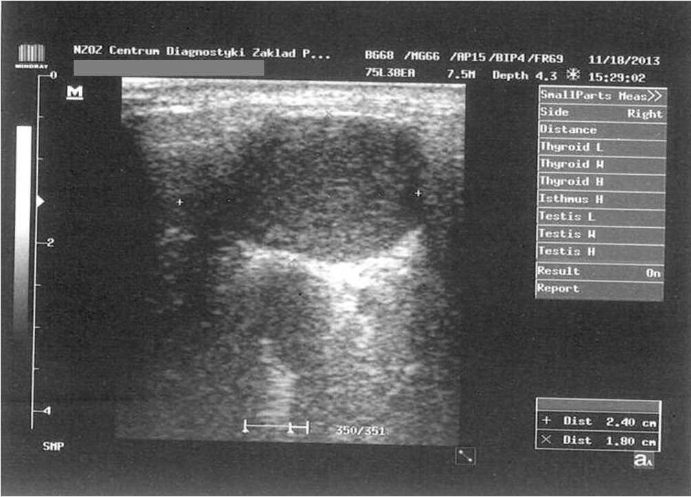 Obraz ultrasonograficzny guza