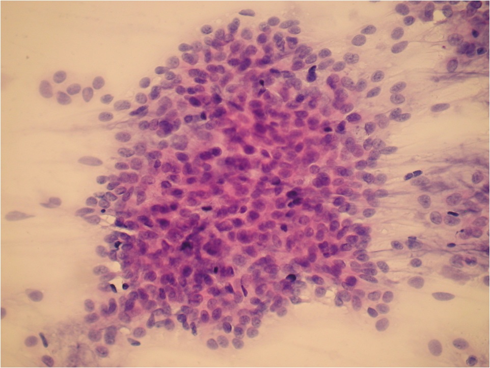Obraz cytologiczny z BAC guza