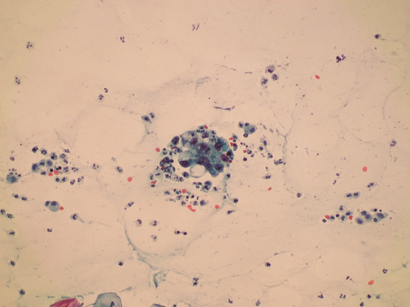 AGC (atypical glandular cells) w cytologii ginekologicznej (obiektyw 20x)