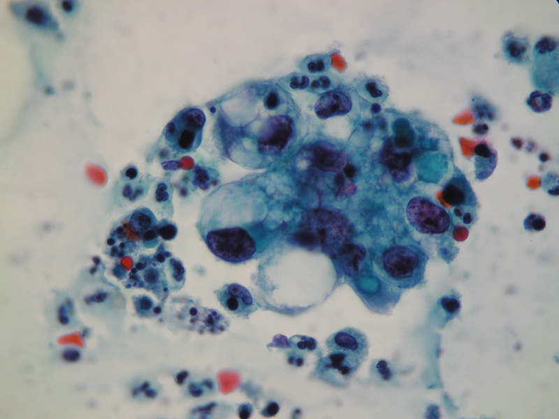 AGC (atypical glandular cells) w cytologii ginekologicznej (obiektyw 100x)