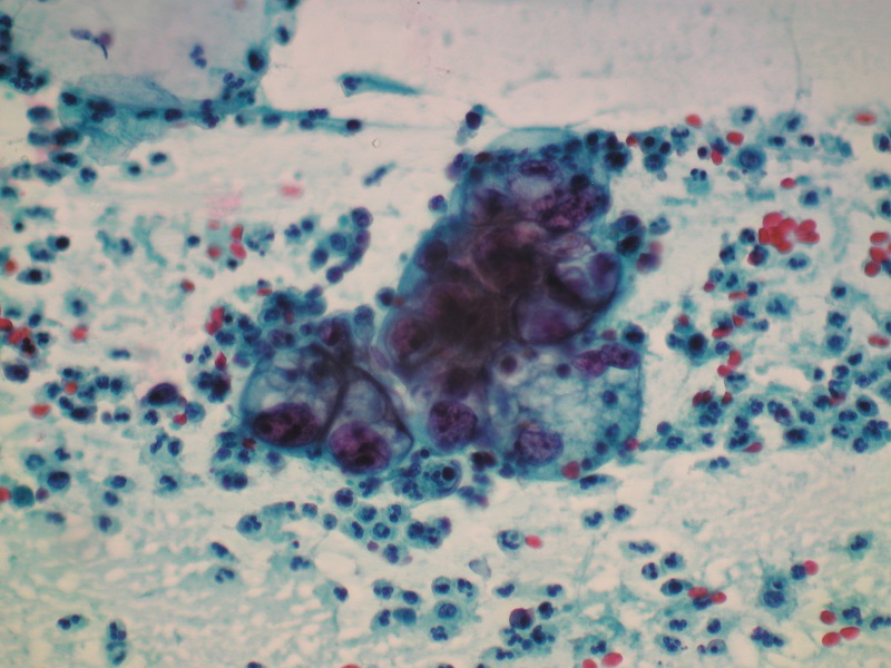 AGC (atypical glandular cells) w cytologii ginekologicznej (obiektyw 40x)
