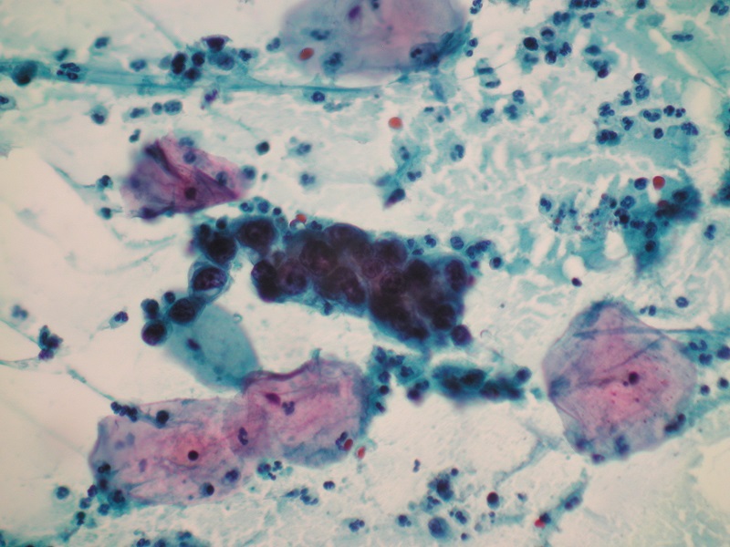 AGC (atypical glandular cells) w cytologii ginekologicznej (obiektyw 40x)