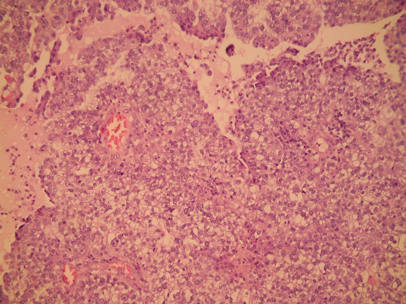Rak gruczołowy jasnokomórkowy – obraz histopatologiczny