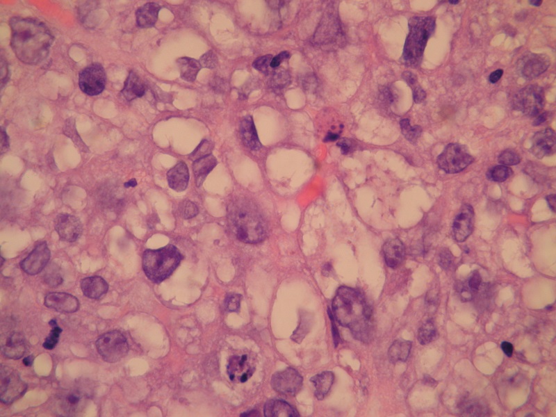 Rak gruczołowy jasnokomórkowy – obraz histopatologiczny