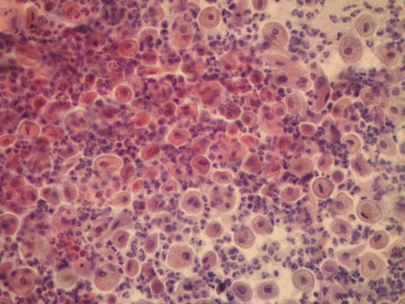 Liczne granulocyty obojętnochłonne w tle rozmazów