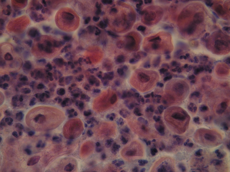 Morfologiczne wykładniki stanu zapalnego występujące pod postacią: powiększonego jądra komórkowego, wakuolizacji cytoplazmy i „halo” około jądrowego