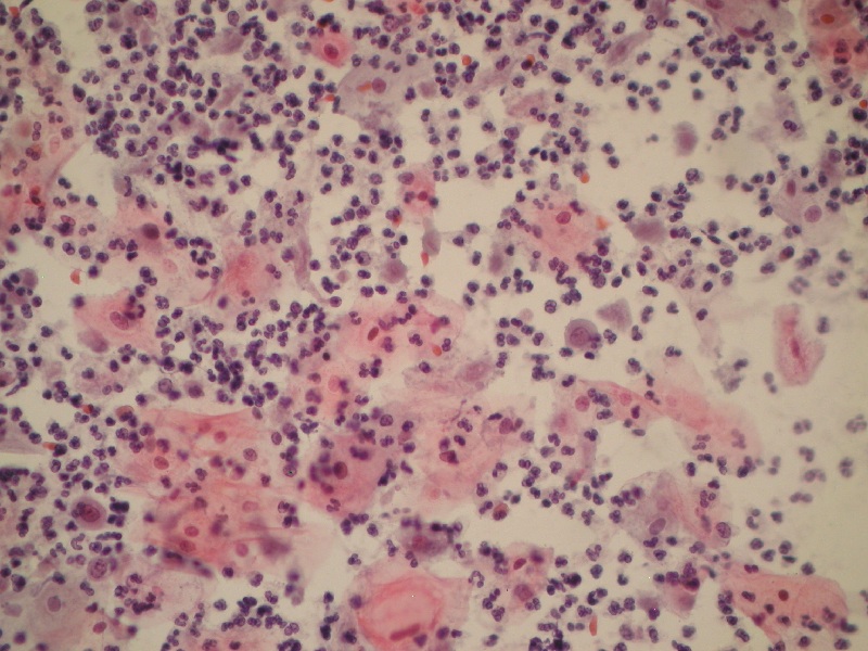 Wzmożona eozynofilia komórek nabłonkowych – zmiana morfologiczna komórek nabłonkowych wywołana infekcją Trichomonas vaginalis