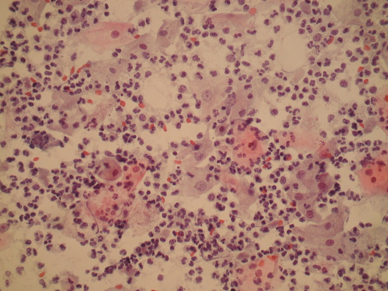 Zmiana jądra komórkowego – anisonucleosis wywołana infekcją Trichomonas vaginalis