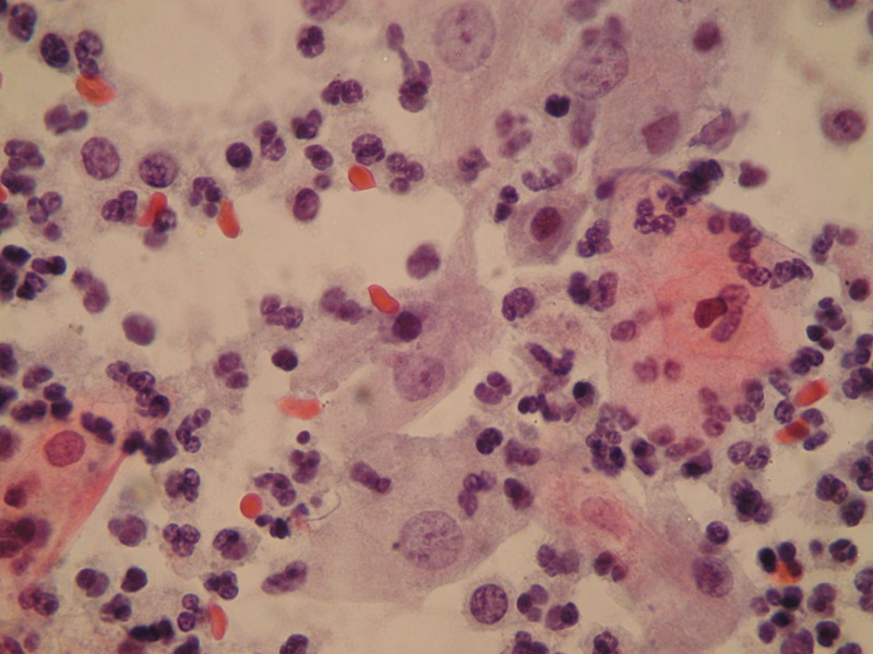 Zmiana jądra komórkowego – anisonucleosiswywołana infekcją Trichomonas vaginalis