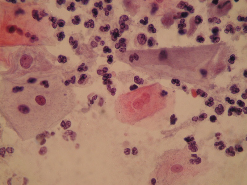 Zmiana jądra komórkowego – dwujądrowość wywołana infekcją Trichomonas vaginalis