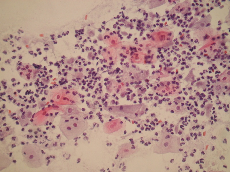 Zmiana jądra komórkowego – małe przejaśnienie (halo) wokół jądra wywołana infekcją Trichomonas vaginalis