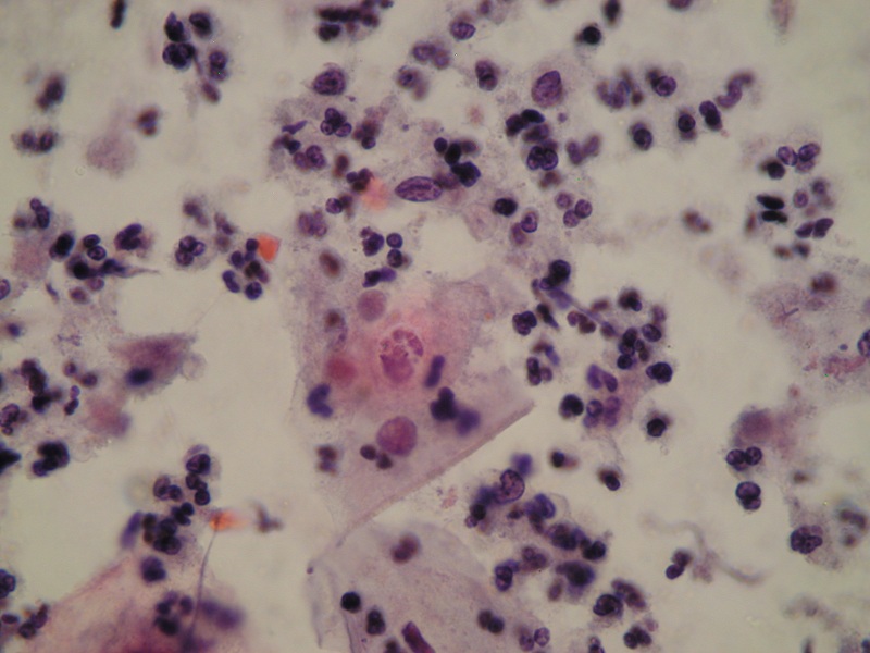 Zmiana jądra komórkowego – karyorrhexis wywołana infekcją Trichomonas vaginalis