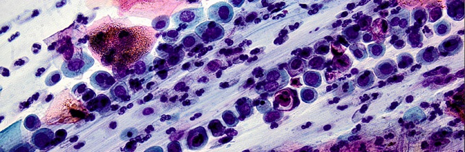 HSIL – obraz cytologiczny
