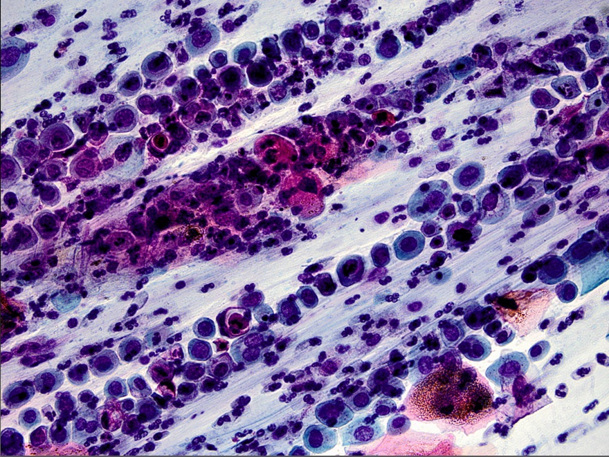Obraz HSIL w cytologii ginekologicznej