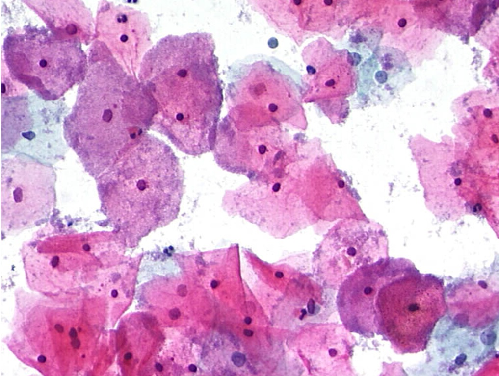 Obraz infekcji bakteryjnej w cytologii ginekologicznej