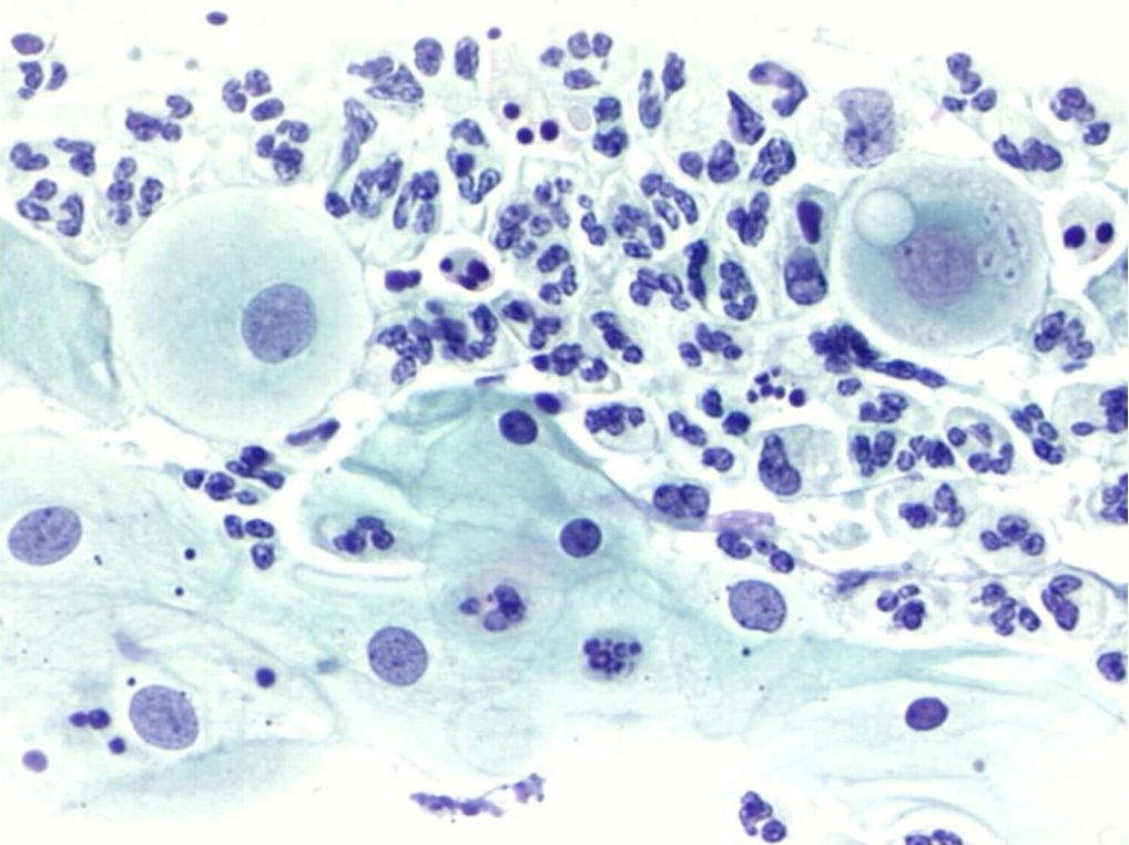 Obraz infekcji Clamydia trachomatis w cytologii ginekologicznej