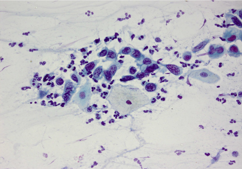 Obraz raka płaskonabłonkowego szyjki macicy w cytologii ginekologicznej