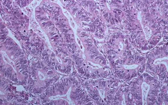 Postępy w diagnostyce nowotworów narządu rodnego_gruczolakorak endometrioidny trzonu macicy