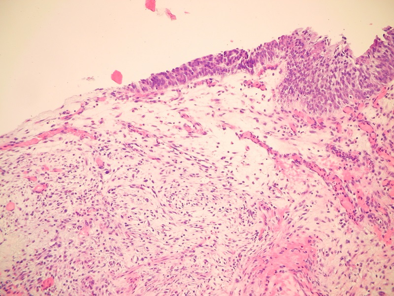 Pooperacyjny guzek z wrzecionowatych komórek (ang.: postoperative spindle cell nodule) pęcherza moczowego