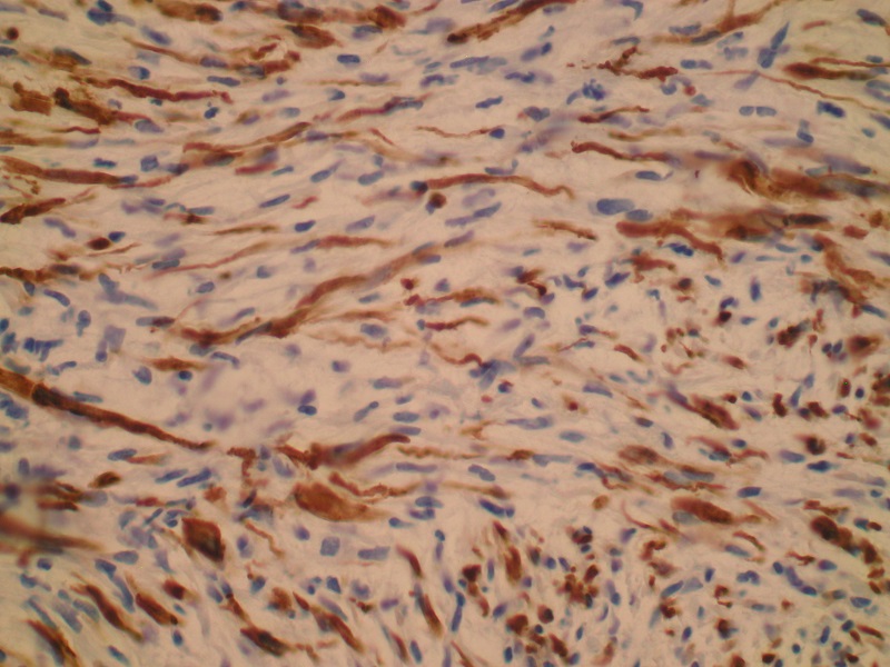Pooperacyjny guz z wrzecionowatych komórek (ang.: postoperative spindle cell nodule) pęcherza moczowego
