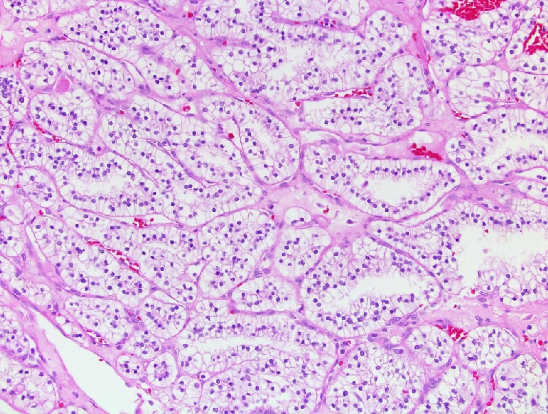Clear cell (tubulo)papillary renal cell carcinoma