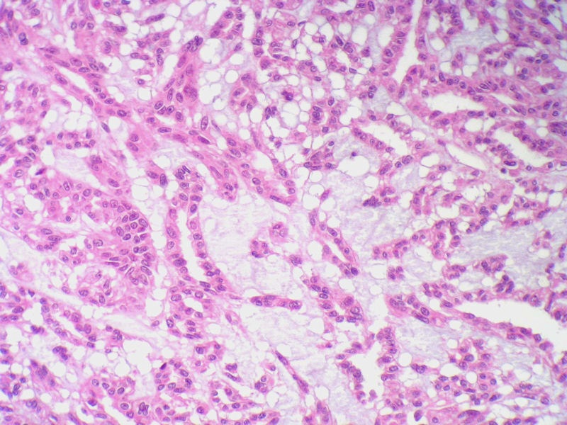 Mucinous tubular and spindle cell carcinoma of the kidney