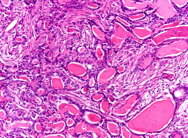Thyroid-like follicular renal cell carcinoma