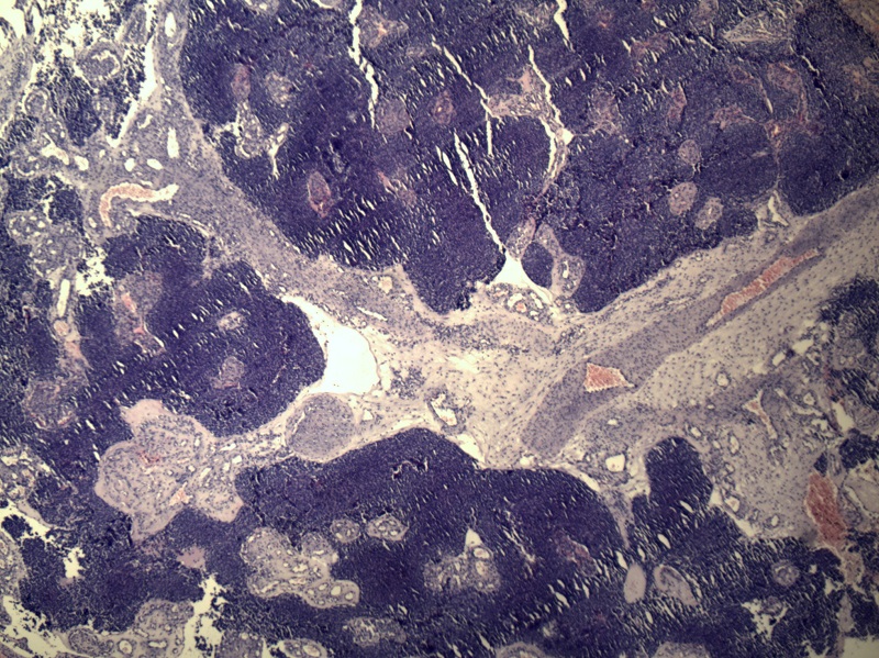 Nerwiak zarodkowy węchowy – nowotwór zbudowany z dobrze odgraniczonych gniazd komórkowych poprzedzielanych pasmami podścieliska łącznotkankowego