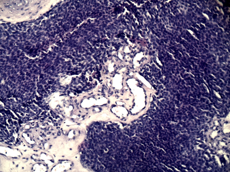 Nerwiak węchowy zarodkowy – w pasmach łącznotkankowych obserwuje się proliferujące naczynia krwionośne oraz drobnowłókienkowe podścielisko (tzw. pilśń neuronalną)