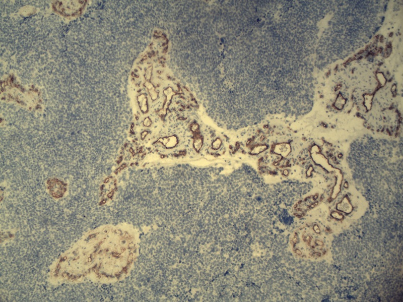 Nerwiak węchowy zarodkowy – barwienie immunohistochemiczne: CD34 – ekspresja dodatnia w proliferujących naczyniach krwionośnych występujących w pasmach podścieliska łącznotkankowego