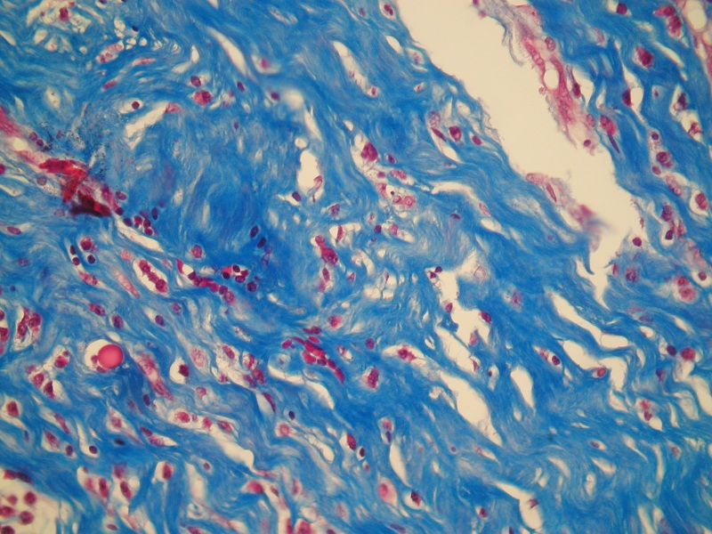 Podścielisko polipa włókniste – podkreślone w barwieniu histochemicznym trichromem Massona