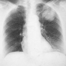 Obraz rtg raka płuca