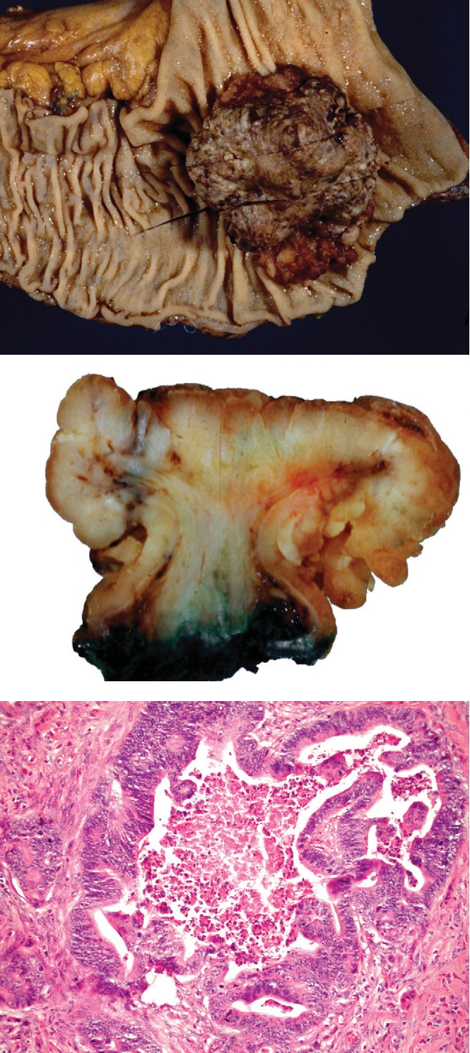 Rak jelita grubego - obraz makroskopowy i mikroskopowy
