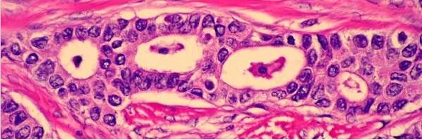 Rak piersi – obraz mikroskopowy