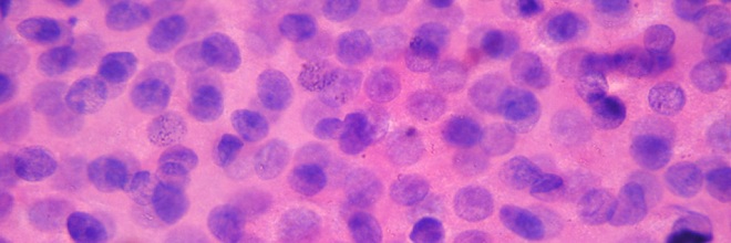 Obraz cytologiczny gruczolaka ślinianki z BAC