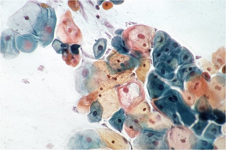 Zmiany w rozmazie cytologicznym szyjki macicy związane z infekcją HPV